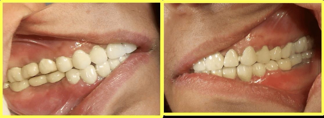Full Mouth Rehabilitation of Multiple Missing and Worn Teeth - Gallery 2