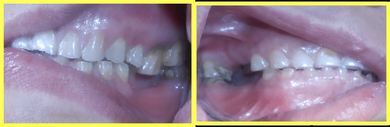 Full Mouth Rehabilitation of Multiple Missing and Worn Teeth - Gallery 1
