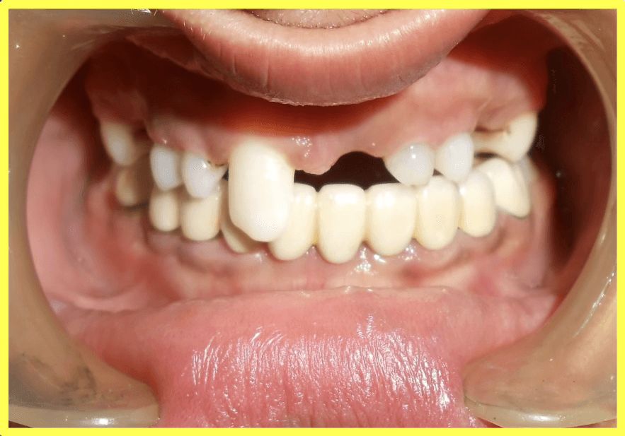 Oligodontia Treatment with Telescopic Prosthesis - Gallery 3