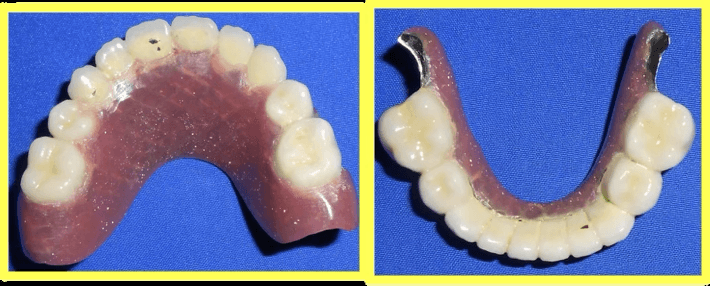 Oligodontia Treatment with Telescopic Prosthesis - Gallery 2