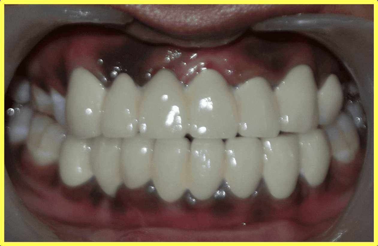 Cosmetic Restoration After Road Traffic Accident - Gallery 1