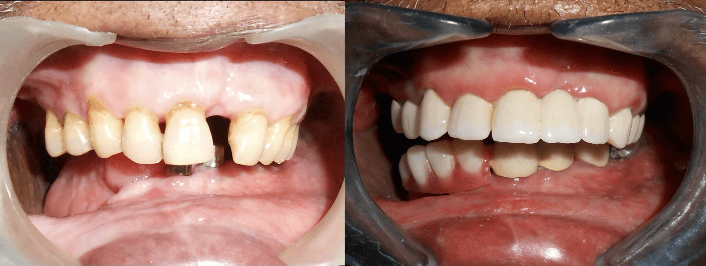 Full Mouth Rehabilitation of Oral Cancer Survivor Patient - Gallery 4