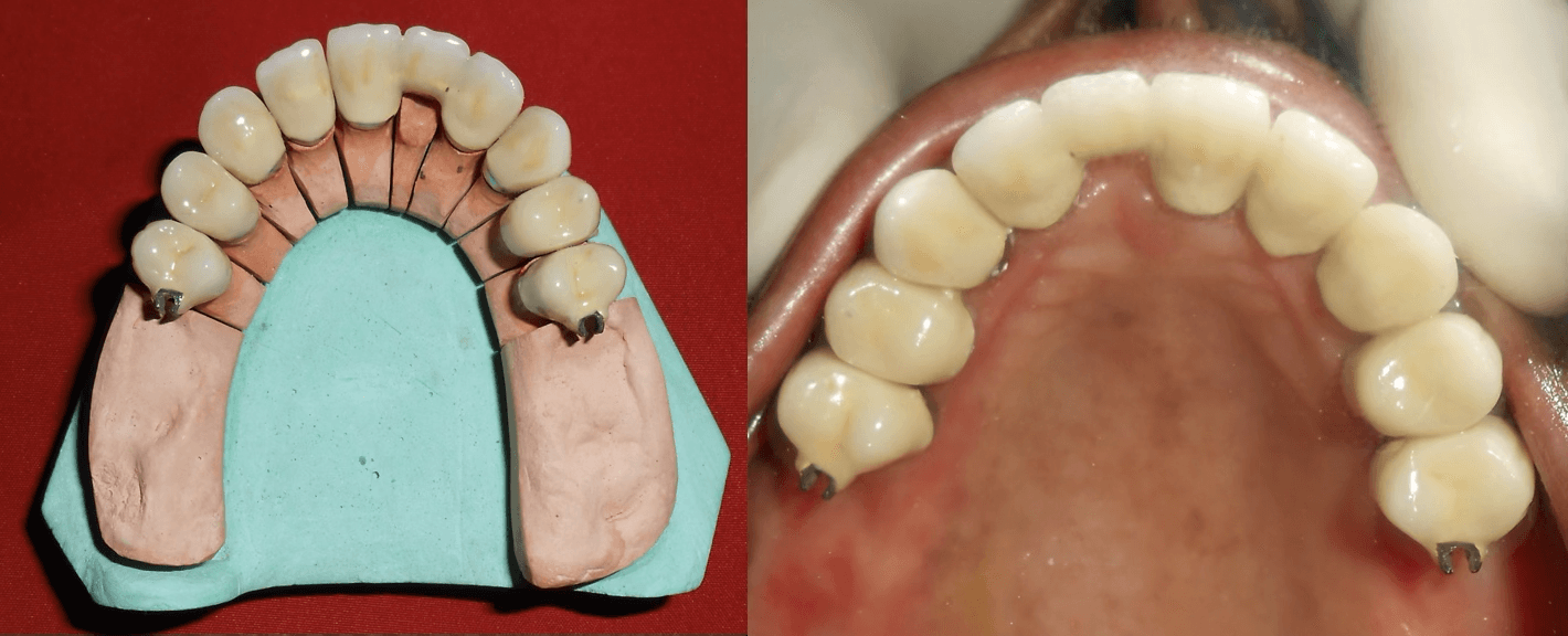 Full Mouth Rehabilitation of Oral Cancer Survivor Patient - Gallery 1