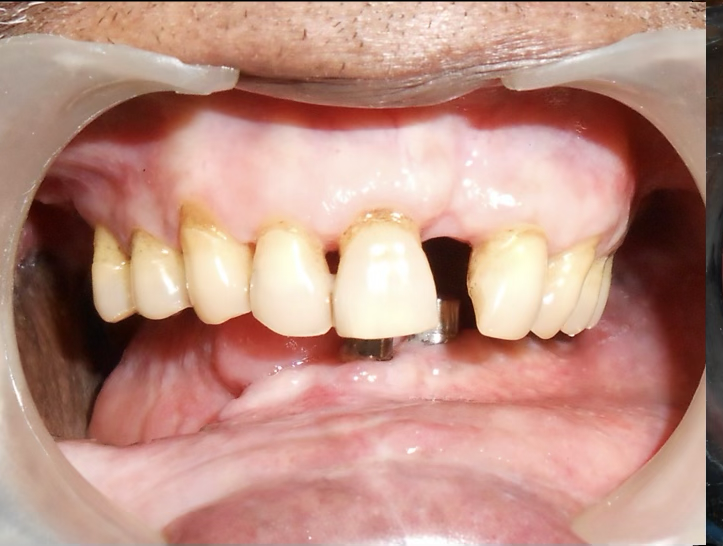 Full Mouth Rehabilitation of Oral Cancer Survivor Patient