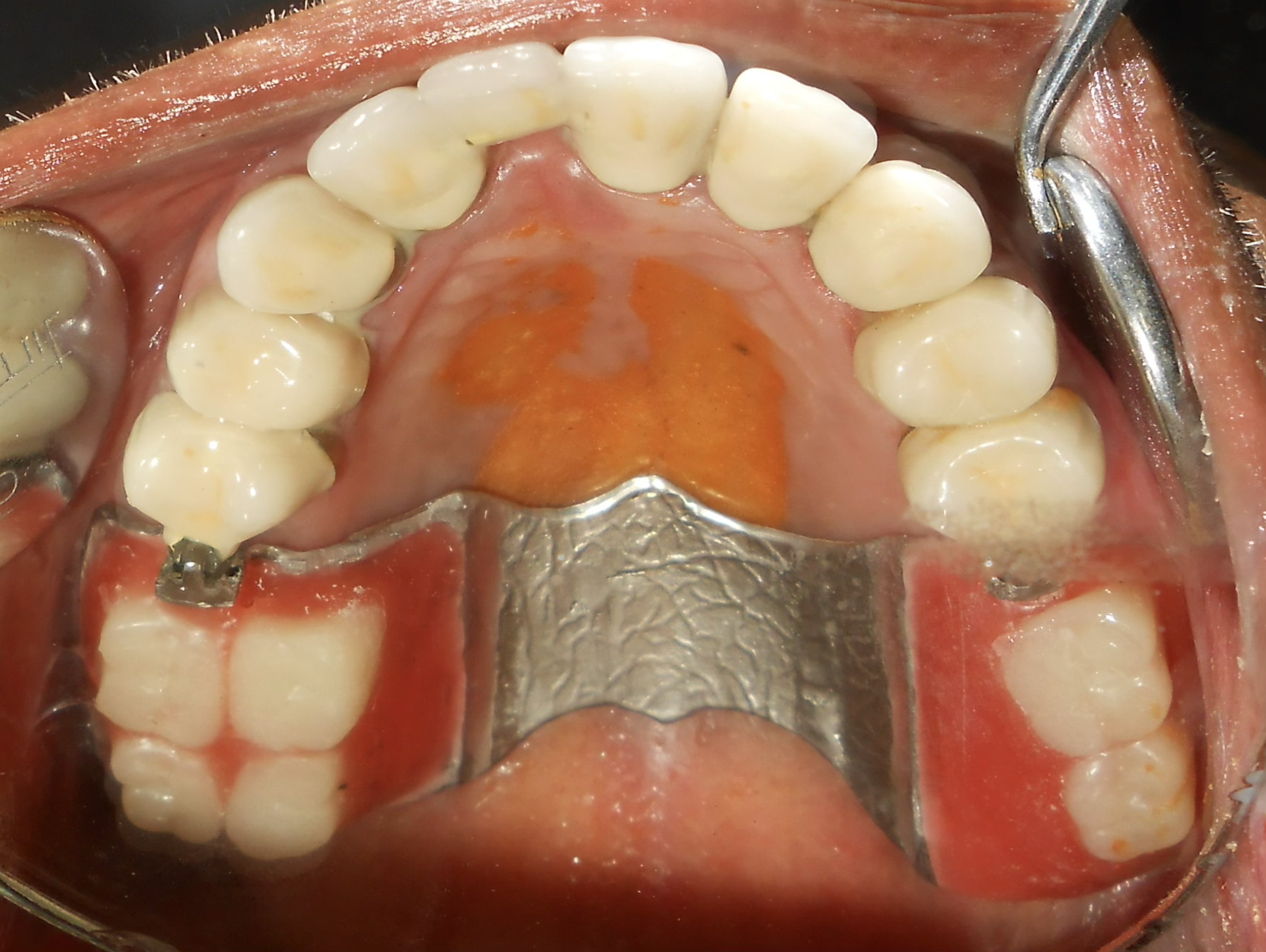 Upper Arch Rehabilitation