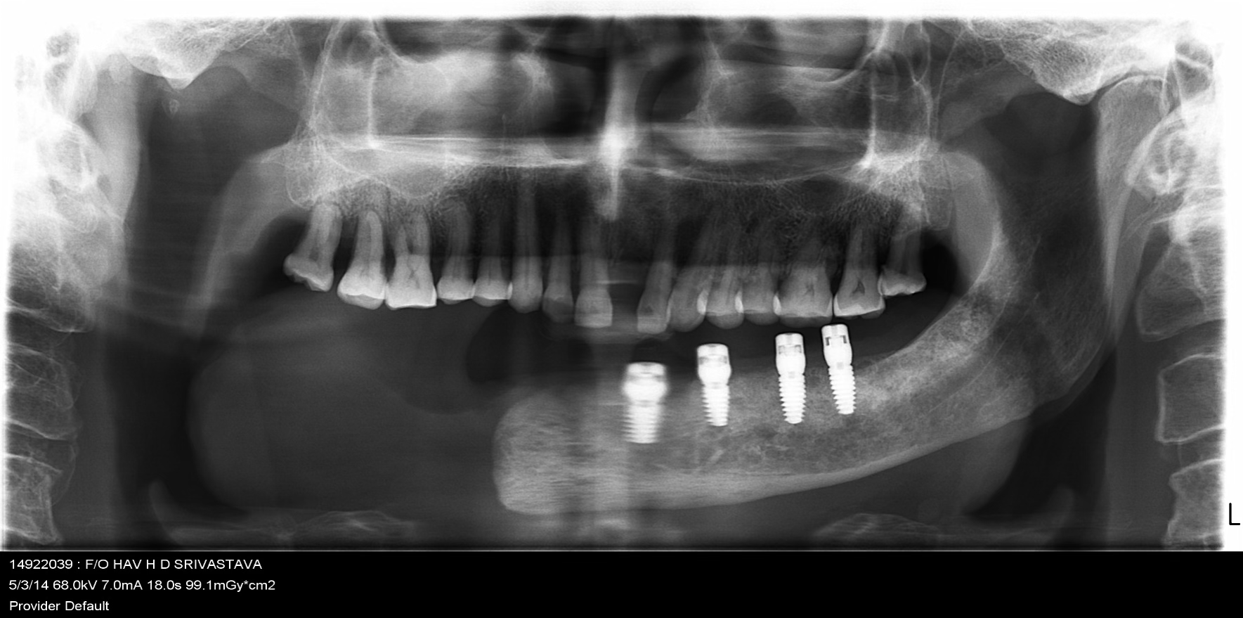 Implant Placement in Hemimandibulectomy Region