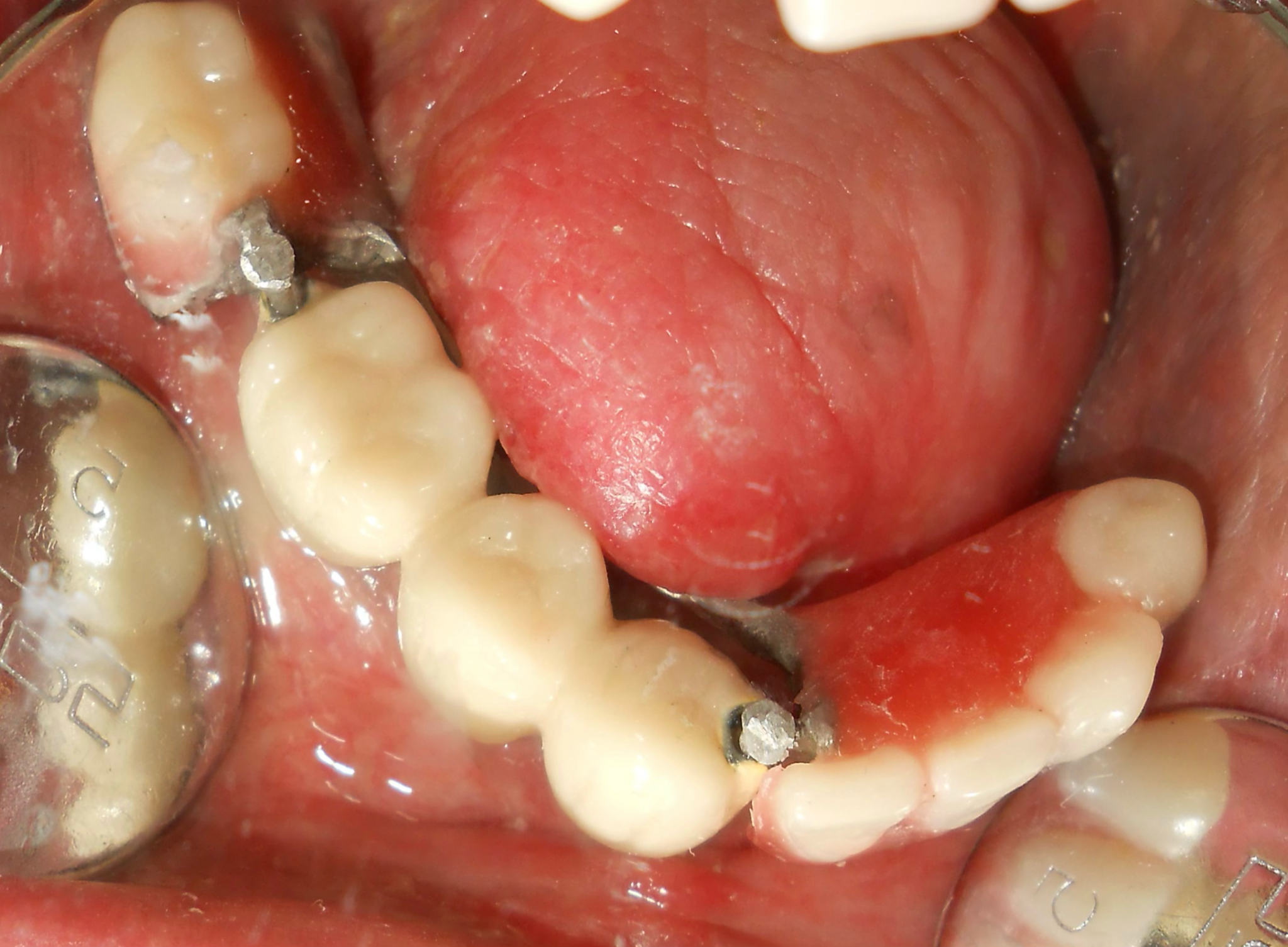 Framework and Teeth Trial
