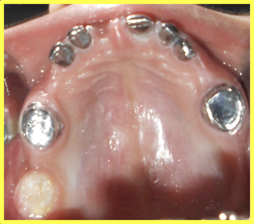 Root Canal Treatment