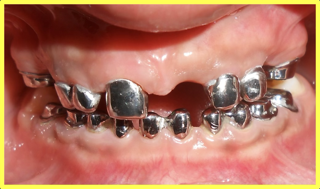 Telescopic Coping Fabrication