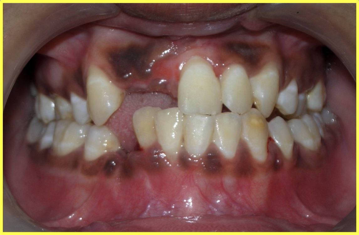 Porcelain Fused to Metal Restorations